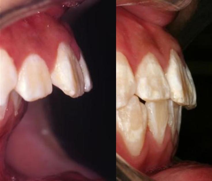 雅悦齿科,做了牙齿矫正容易得牙龈萎缩吗