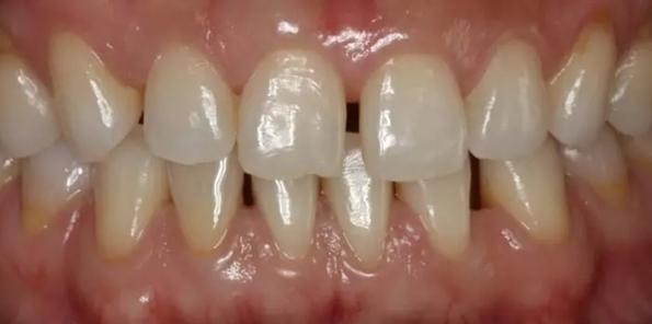 牙龈萎缩黑三角塞牙,牙齿黑三角如何让牙龈长出来