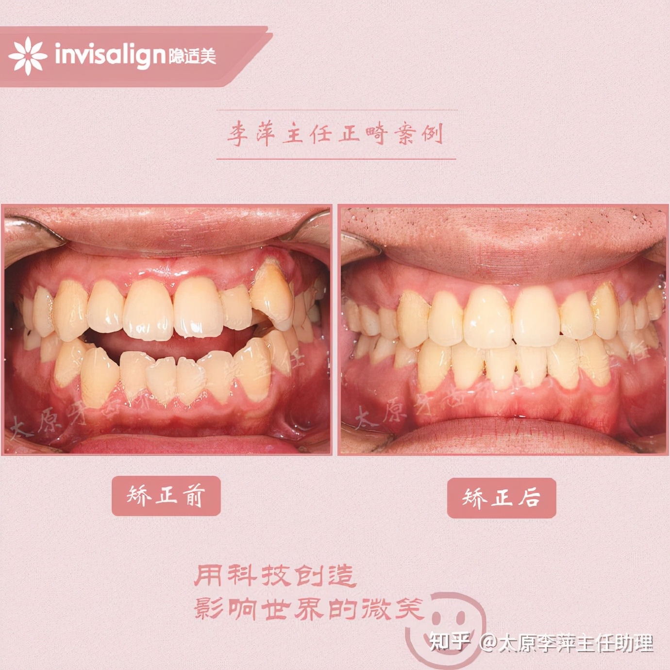太原矫正牙齿需要做正颌吗,太原牙齿二次矫正