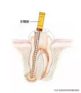 “根管不通”是怎么回事?