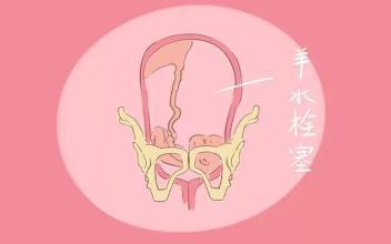 只知道羊水栓塞可怕，其他知识不了解一下？