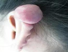 以前不是疤痕体质现在怎么留疤了,受伤了愈合之后为什么会留疤