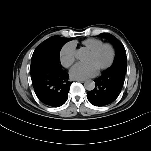 如何监测动脉夹层早期,动脉增强ct能查出主动脉夹层么