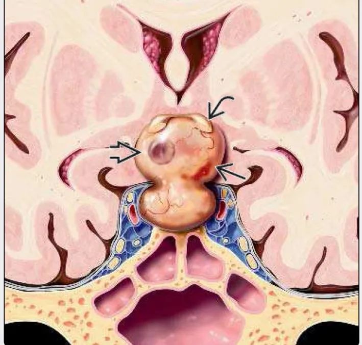 脑子里有4毫米的瘤,脑子里为什么会长瘤