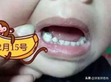 小孩没换牙有了蛀牙疼痛怎么办,小孩蛀牙疼痛怎么办止痛