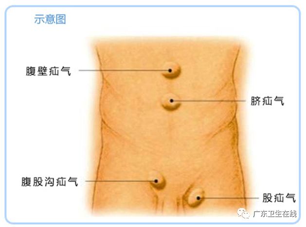 疝气除了手术还有别的治疗方法吗,疝气手术可以局部麻醉吗