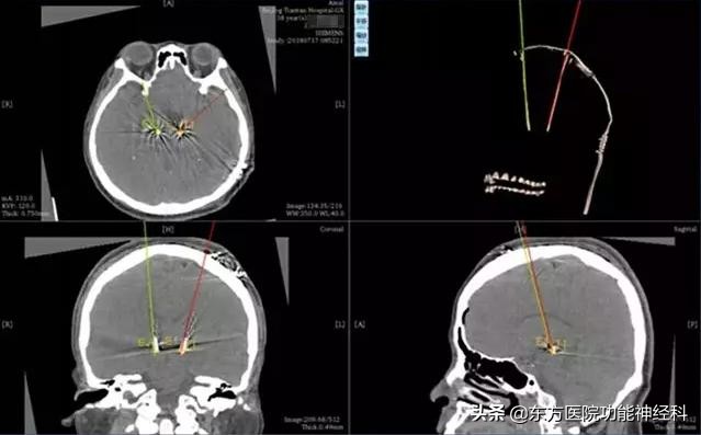 东方医院带你探究DBS能治疗哪些病？