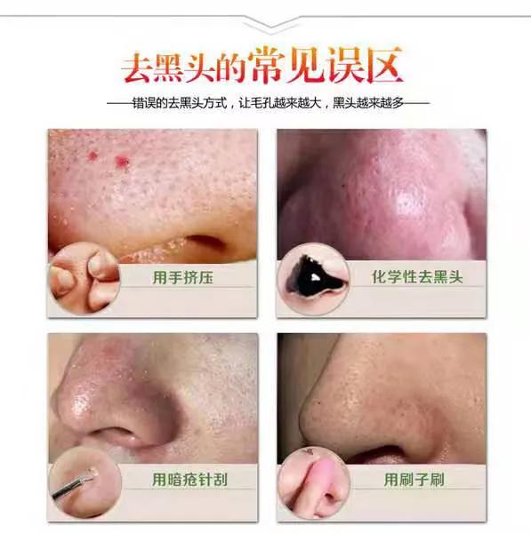 怎么解决糟心的黑头,怎么才能看清楚自己脸上的黑头