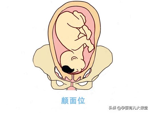 37周脐带绕颈2圈矫正图片胎位不正,孕妇胎位不正的原因及纠正方法