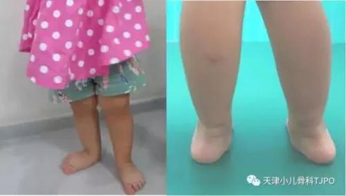 8岁孩子足外翻有必要治吗,骨科医生谈幼儿脚内扣