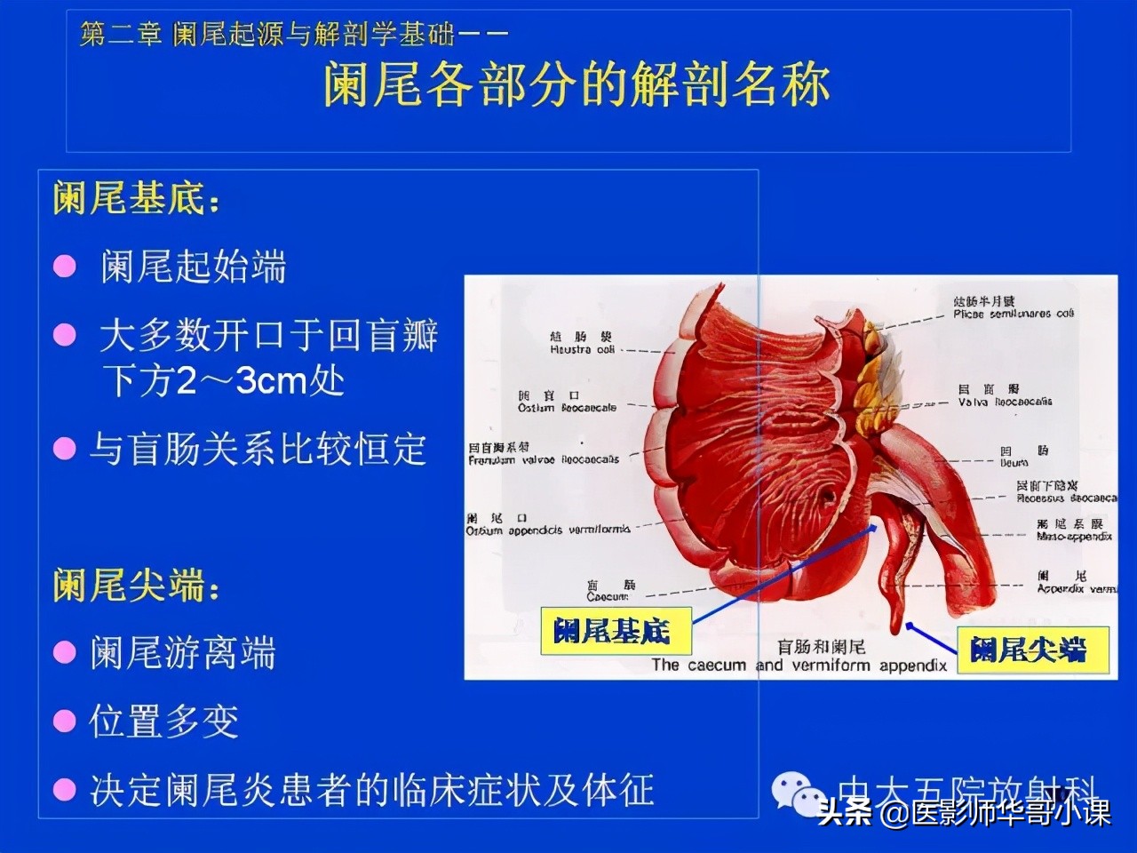 阑尾炎课件,阑尾炎的超声课件