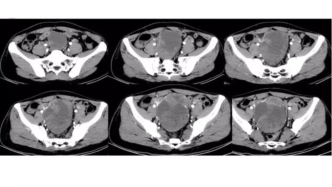 卵巢原发肿瘤的分析思路