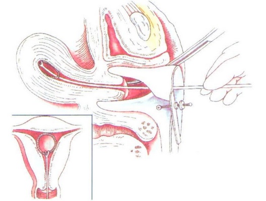 避孕环、节育环、宫内节育器,到底是个啥?
