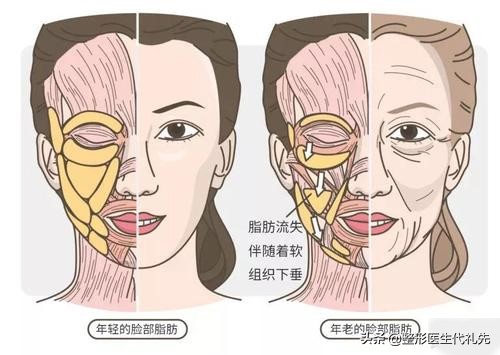 面部埋线提升能维持多久,面部埋线提升