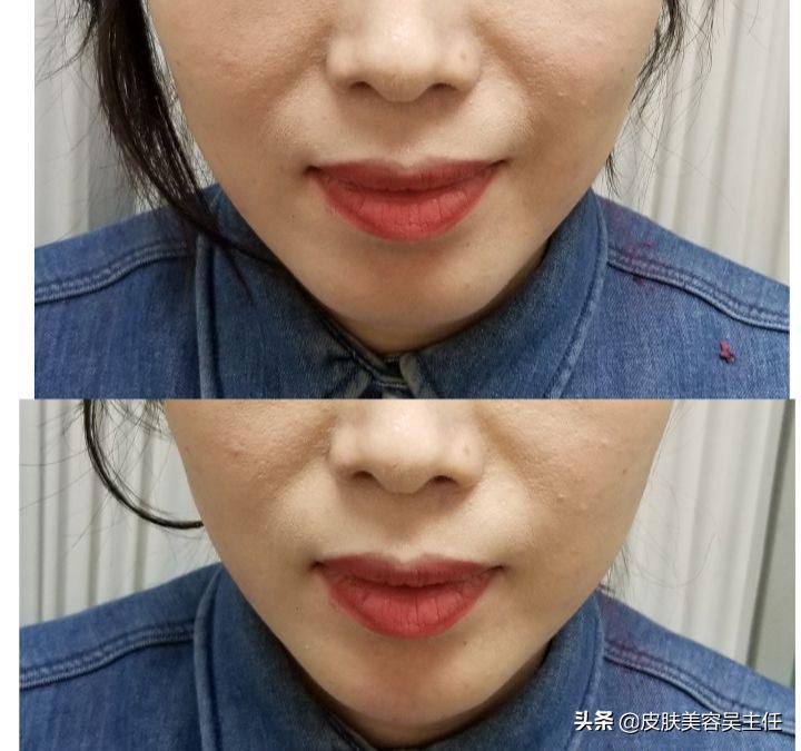 打玻尿酸成假脸,注射玻尿酸后出现假脸