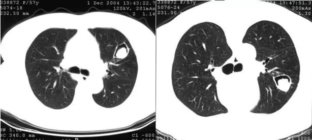 肺部ct十大征象,肺部ct正常图和异常图的区别