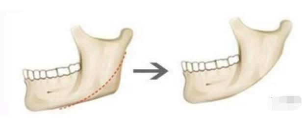 那些一刀切削骨的明星还好吗？后遗症一大堆，小方脸成最大赢家