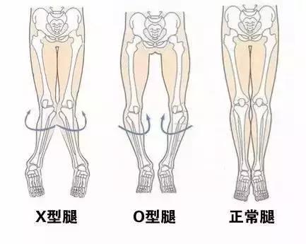 宝宝腿什么样是正常的,婴儿腿弯是o型腿吗