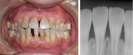 牙龈萎缩牙齿松动怎么挽救,牙龈萎缩牙齿松动严重怎么处理