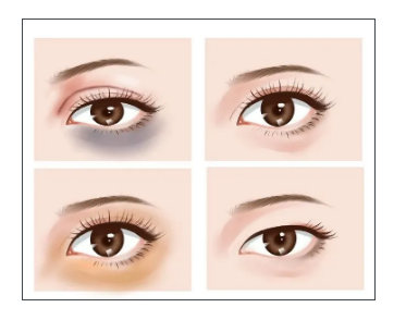 拯救黑眼圈泪沟的偏方,纯干货史上最全的对付黑眼圈攻略