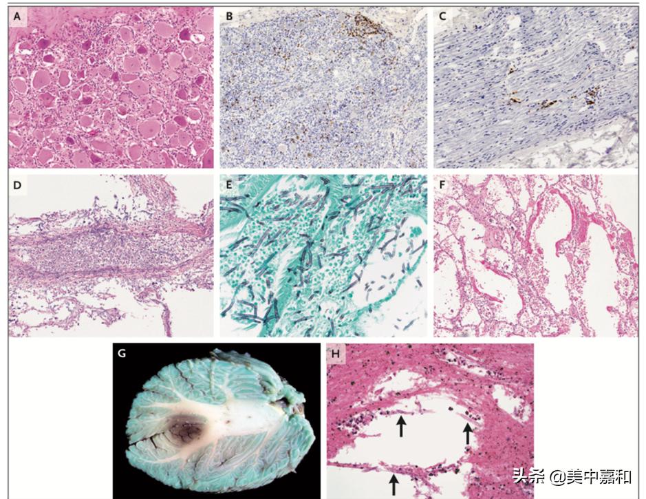 转移性恶性黑色素瘤治愈率,黑色素瘤早期切除后免疫治疗