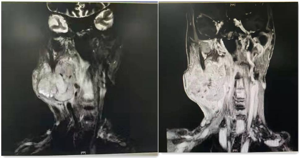 良性腮腺肿瘤术后注意事项,腮腺肿瘤手术后注意事项和护理