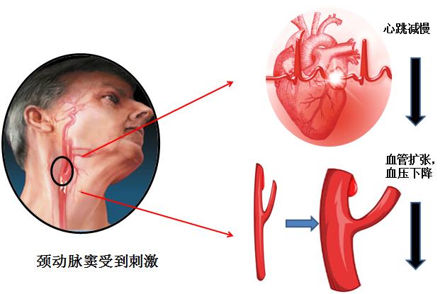 一个吻痕引起的致命性脑梗死事件，医生为你图说其中的机制