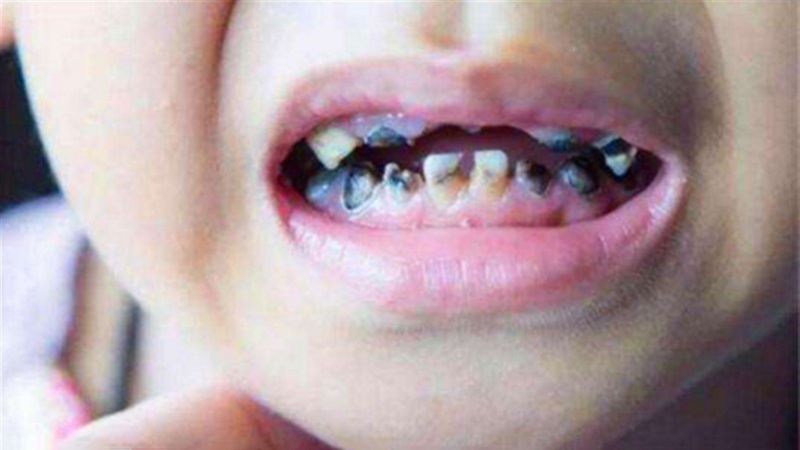 5岁儿童长蛀牙了会换牙吗,孩子蛀牙是不是换了新牙就没事了