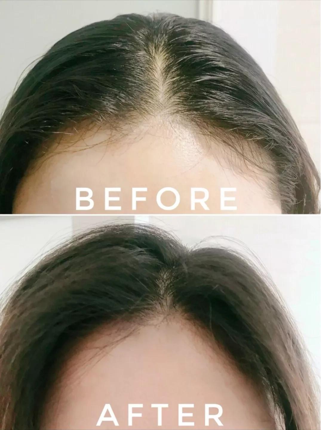 头皮痒出油有螨虫怎么解决,头皮痒出油起螨虫怎么办