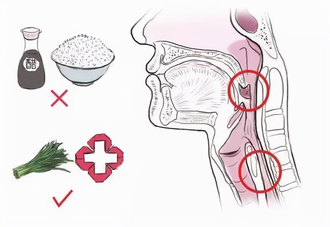 胃食管反流病健康小知识,食管异物的健康宣教