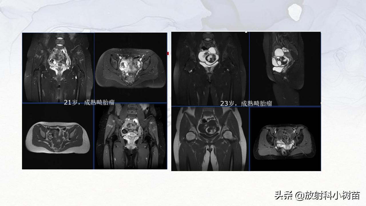 女性盆腔mri解剖图谱,泌尿生殖系统x线解剖