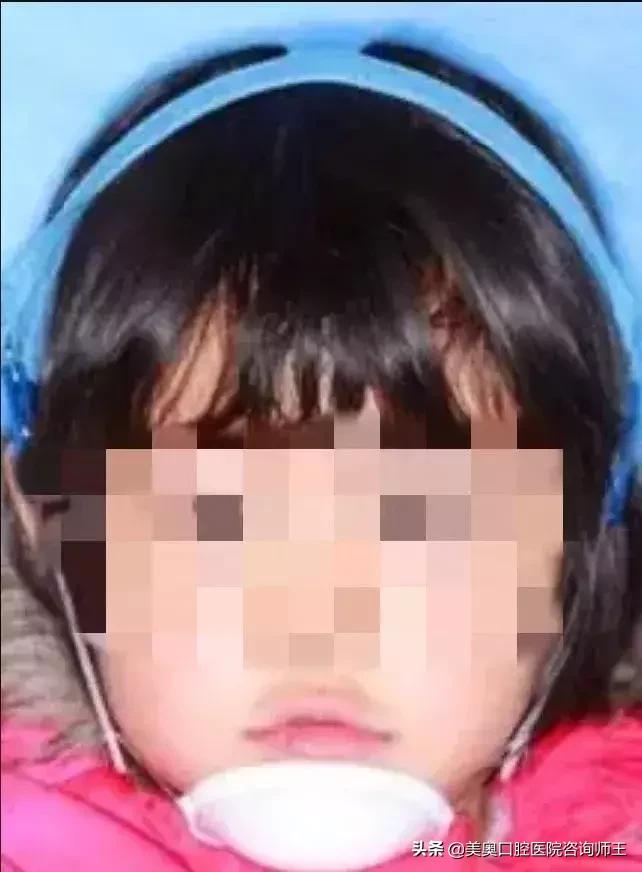 牙齿矫正地包天多久能看到效果,地包天越早矫正越好吗