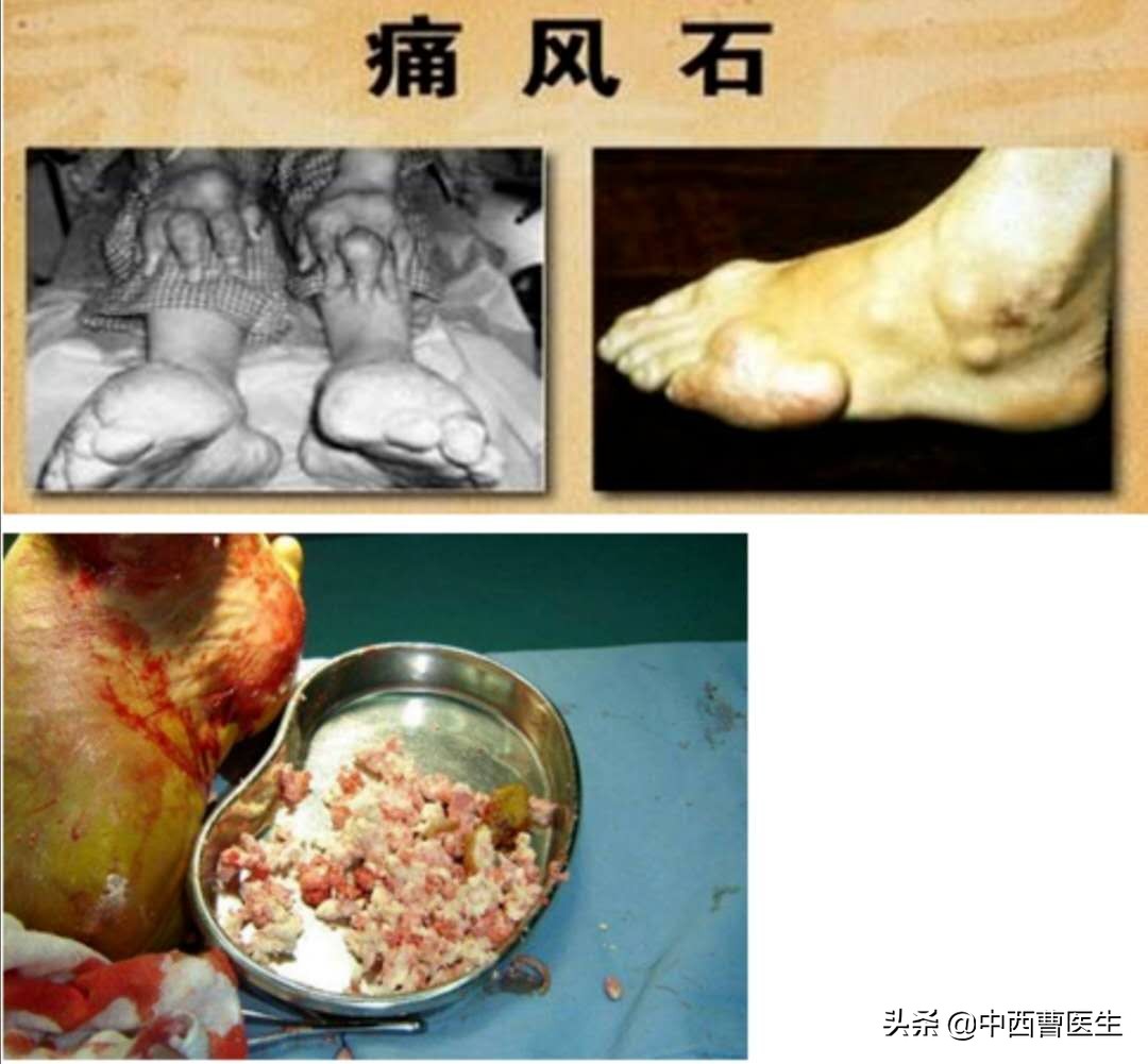 痛风的临床表现及健康教育ppt,痛风的诊断与治疗的内容