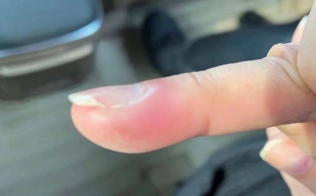 手上倒刺最简单的去除方法,预防手指生倒刺的小妙招