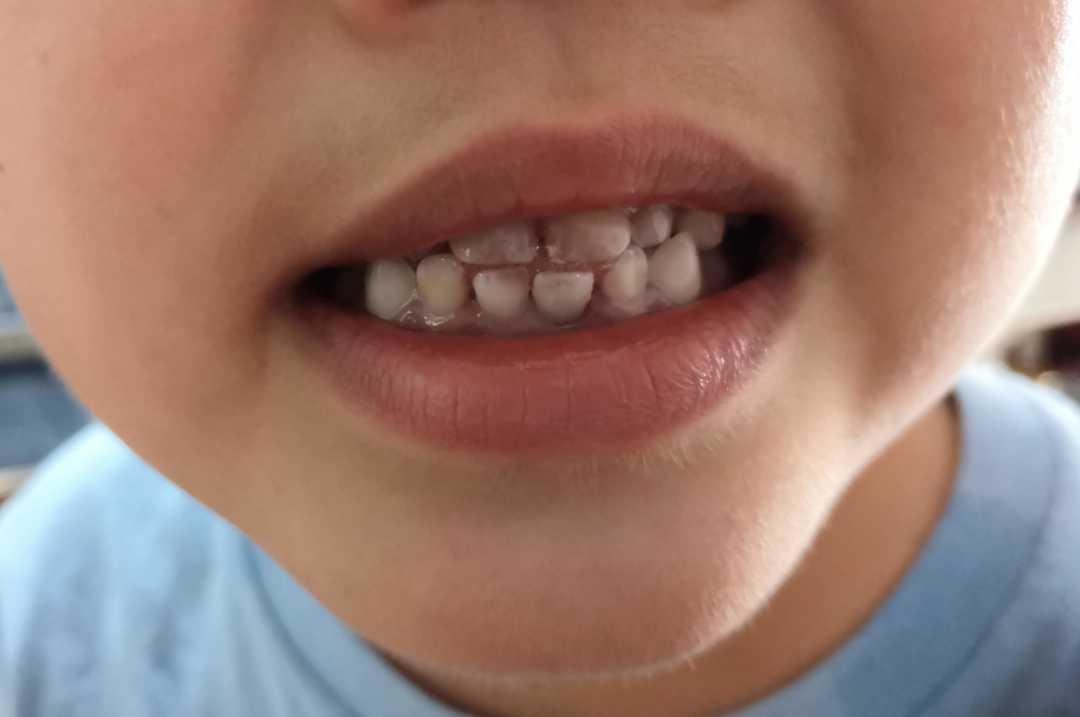 六岁儿童换牙时要拔牙的最佳时间,5岁孩子换牙乳牙松动不掉