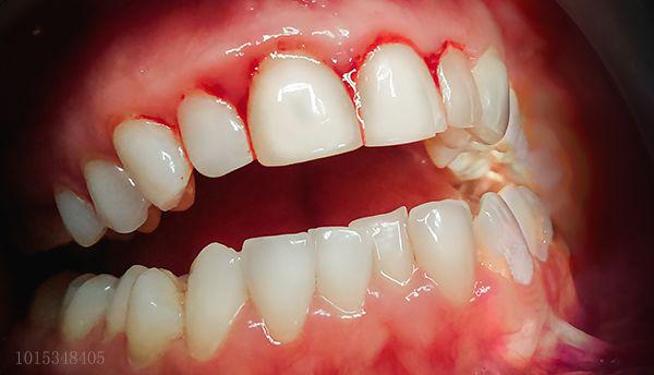 请问一下牙医牙齿松动是什么原因,牙齿松动看北大口腔医院哪个科