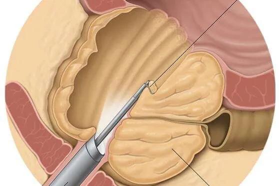 一小时解除多年顽疾，老人家再也不用四处找厕所