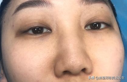 为什么医生都反对线雕隆鼻,到底要不要做线雕隆鼻