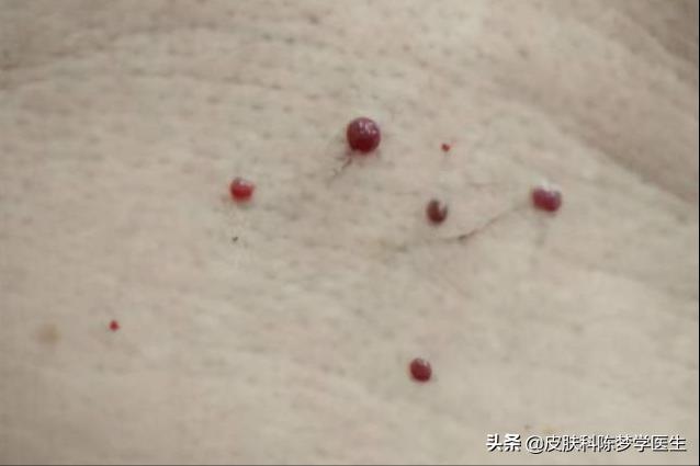 脖子上长了几个针尖大的肉球,脖子上长了丝状疣是感染了hpv吗