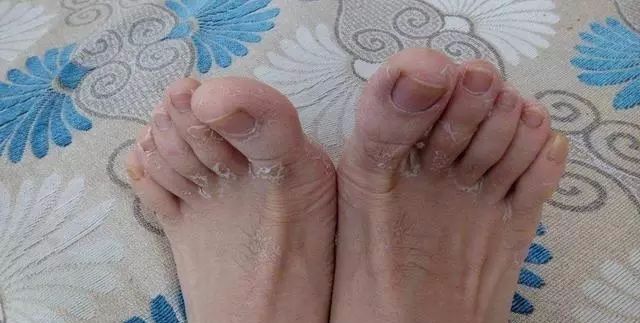 双脚干裂起硬皮怎么办,双脚干燥起皮