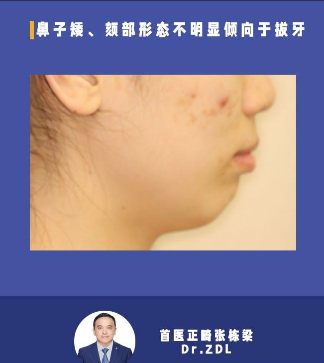 戴牙套矫正牙齿脸型会变好看吗,隐形牙套矫正后脸型变化