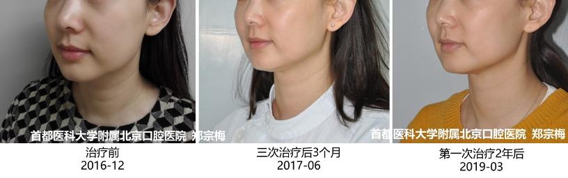 追求素颜肌必做项目之光子嫩肤——皮肤的“十全大补丸”