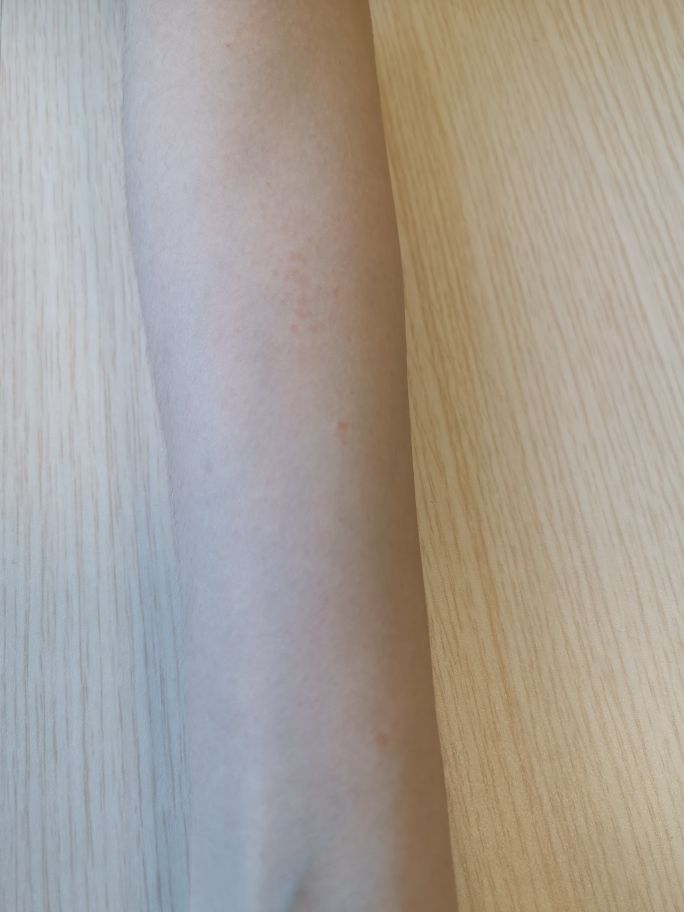 长成圆圈形状是癣还是湿疹,线状苔藓是什么原因造成的