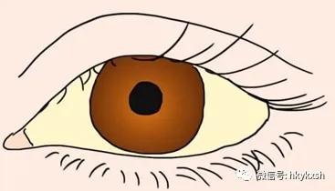 今日科普||甲型肝炎