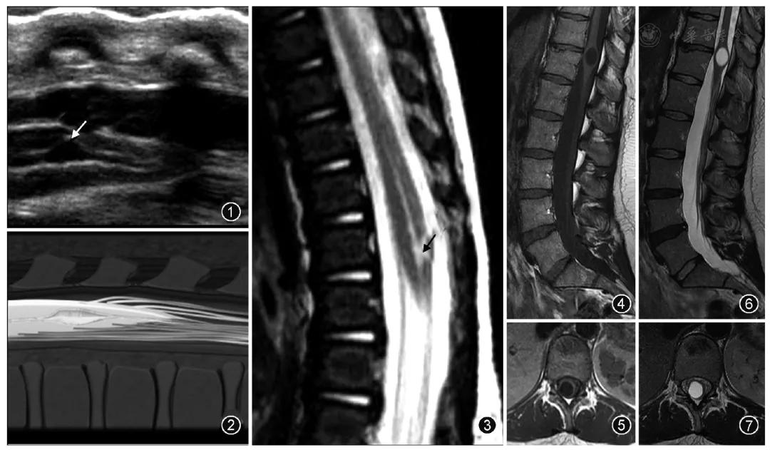 脑室透明隔间腔,第五脑室是什么意思