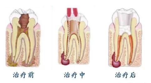根管治疗后戴冠是什么意思,根管治疗后为什么要戴牙套