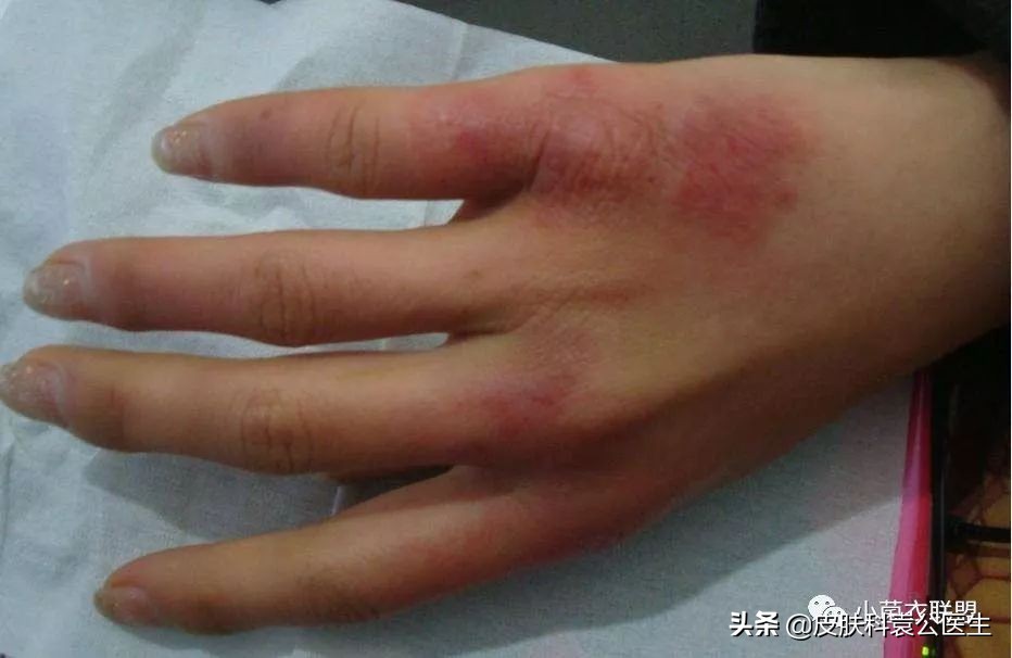 冻伤后痒痒是怎么回事,冻伤瘙痒