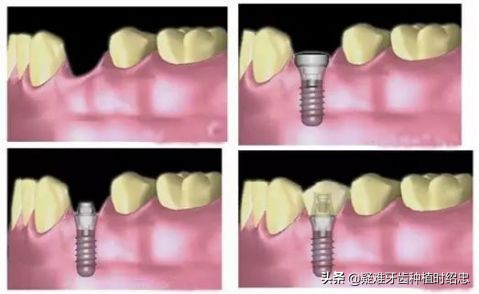 治牙费用一般多少钱,儿童治牙费用