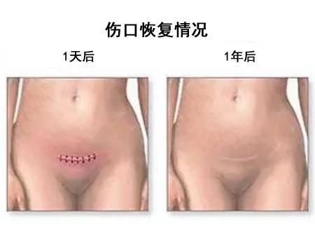 剖腹产让人感动的话,剖腹产出来感人时刻