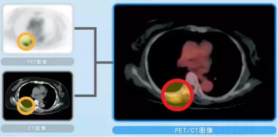 外国早期筛查癌症,petct用于诊断癌症
